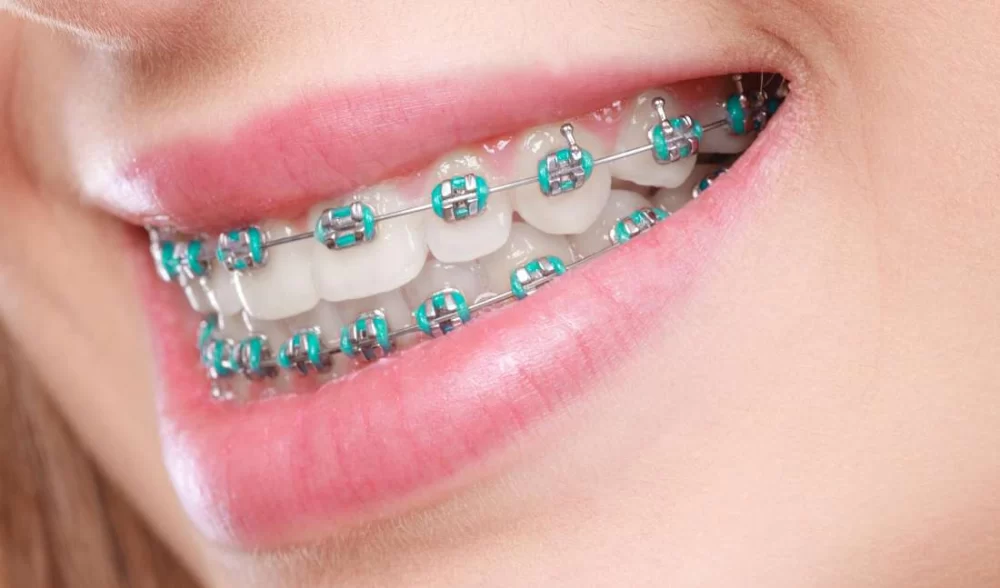 Best Dental Care Routine for Braces to Keep Your Smile Healthy and Bright