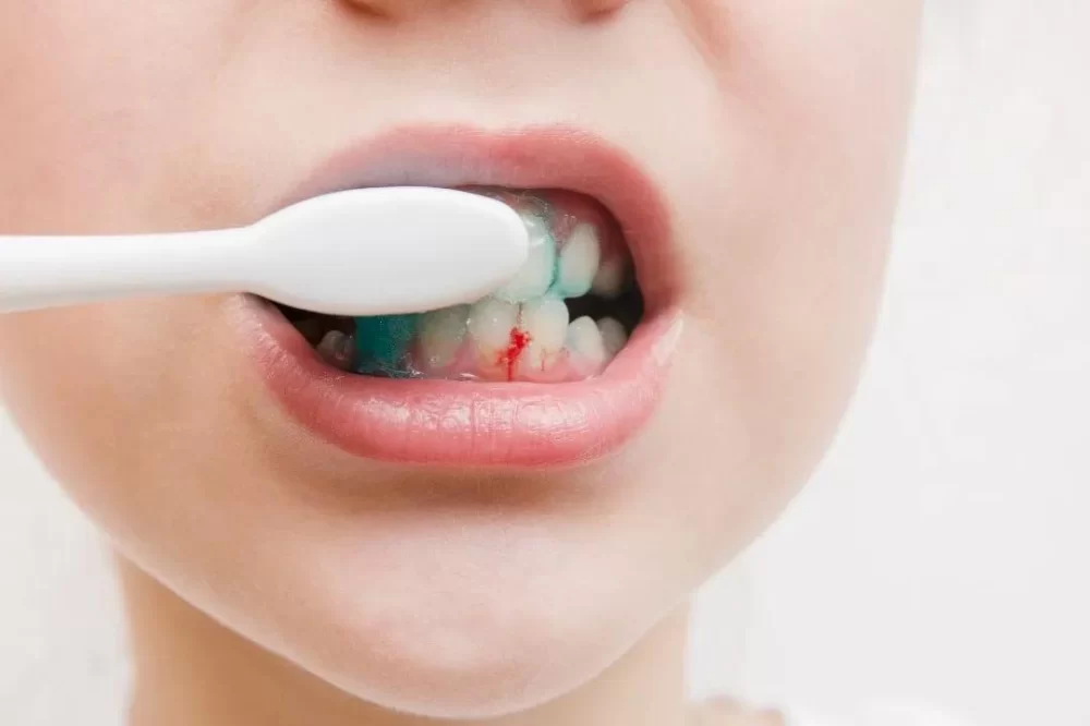 Effective Ways to Prevent Gum Bleeding During Flossing for Healthier Gums