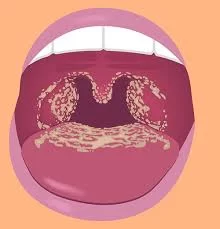 Recognizing Signs of Oral Candidiasis Infection: Symptoms and Effective Treatment Options