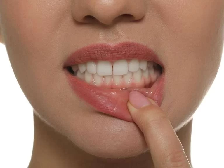 Understanding the Early Signs of Receding Gums and How to Protect Your Oral Health