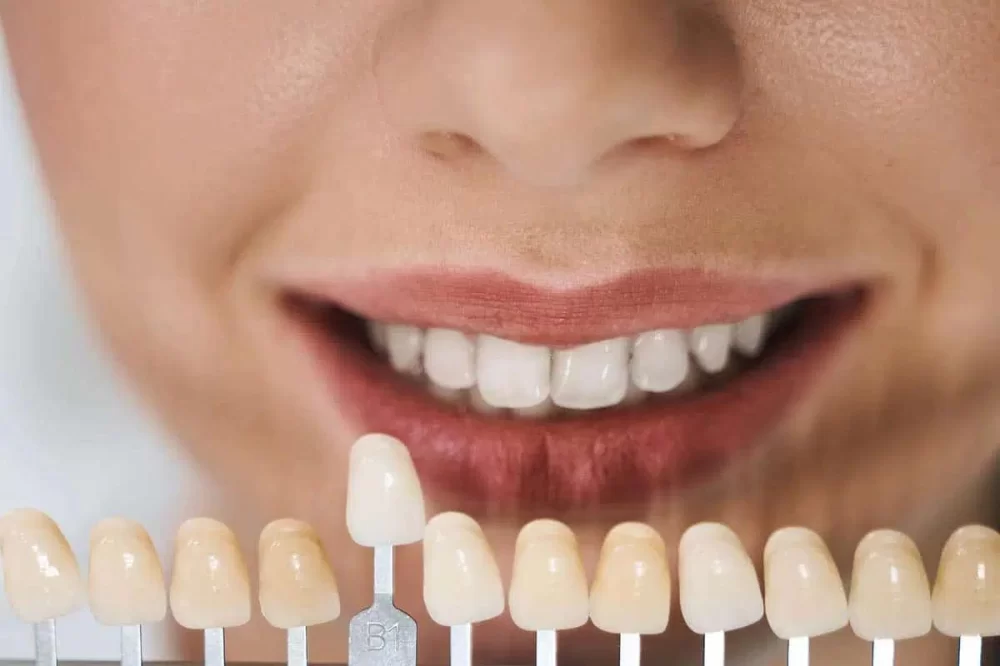 Comprehensive Guide on Caring for Dental Veneers After Placement and Maintenance