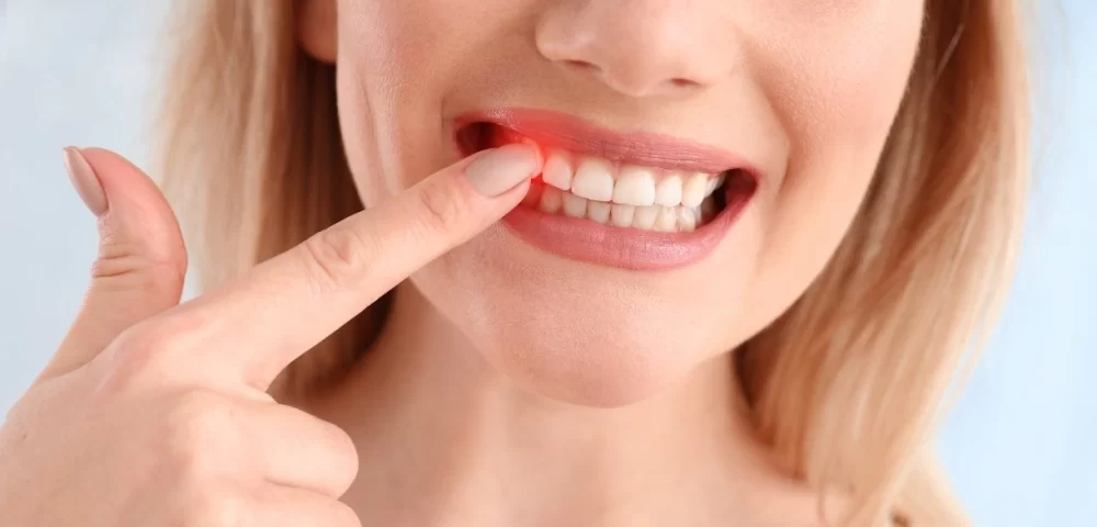 How to Prevent Gum Bleeding After Dental Cleaning and Surgery Care