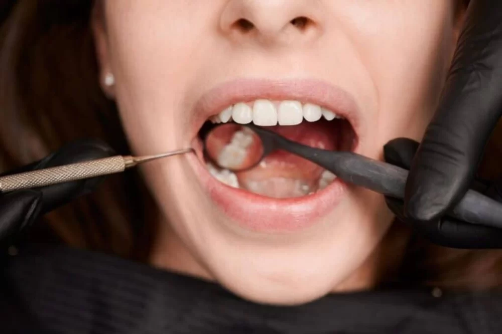 Effective Tooth Decay Prevention Tips for a Healthier Smile