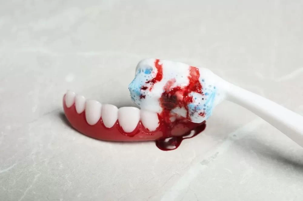 Effective Ways to Treat Bleeding Gums Caused by Brushing Too Hard