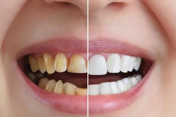 How to Prevent Tooth Decay Using Fluoride Toothpaste and Professional Treatments