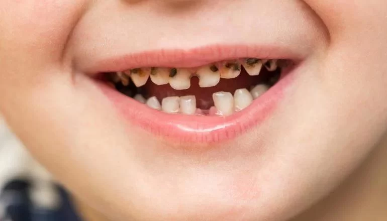 Practical Ways to Prevent Tooth Decay in Infants and Toddlers with Effective Care