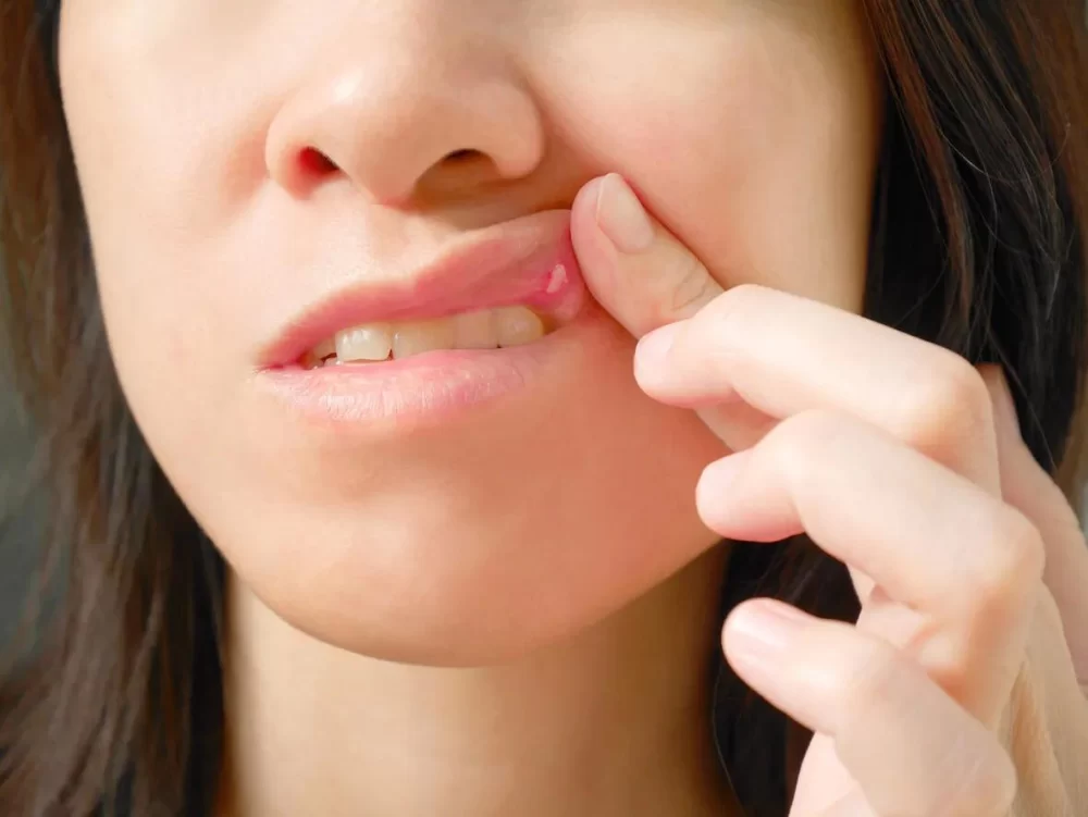 Natural Ways to Treat Canker Sores Caused by Stress and Infection