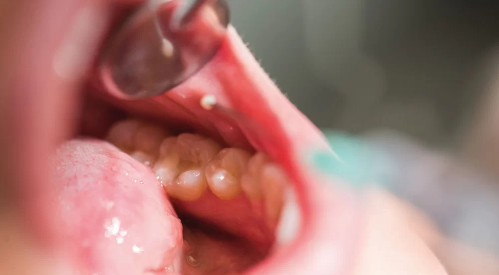 Effective Ways to Prevent Oral Cancer Through Lifestyle Changes and Screenings
