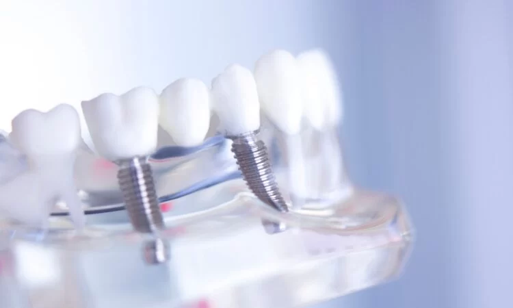 How to Maintain Oral Hygiene with Dental Bridges Effectively and Safely