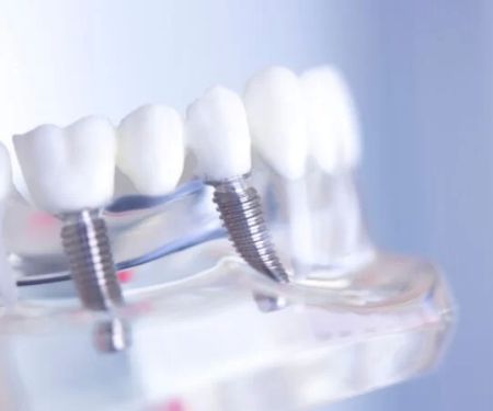 How to Maintain Oral Hygiene with Dental Bridges Effectively and Safely