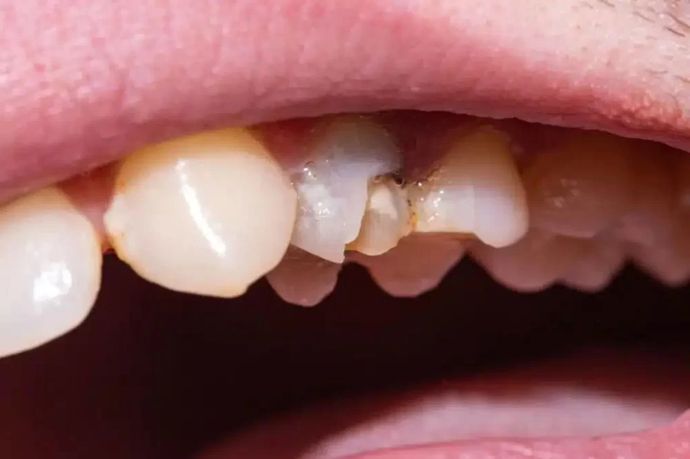 Understanding the Signs of Dental Erosion and How to Protect Your Teeth