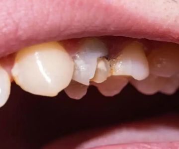 Understanding the Signs of Dental Erosion and How to Protect Your Teeth