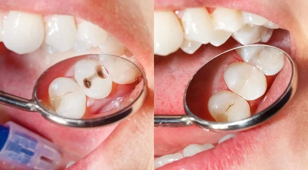 Dental Crown vs Filling: Choosing the Best Option for Tooth Restoration