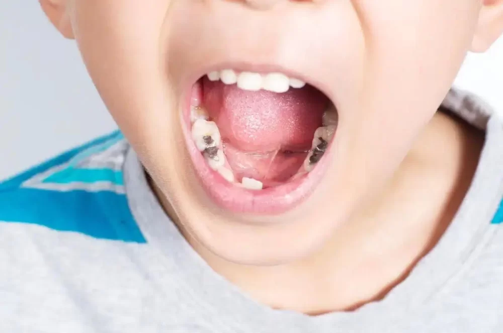 Common Causes of Tooth Pain After Filling and How to Manage It