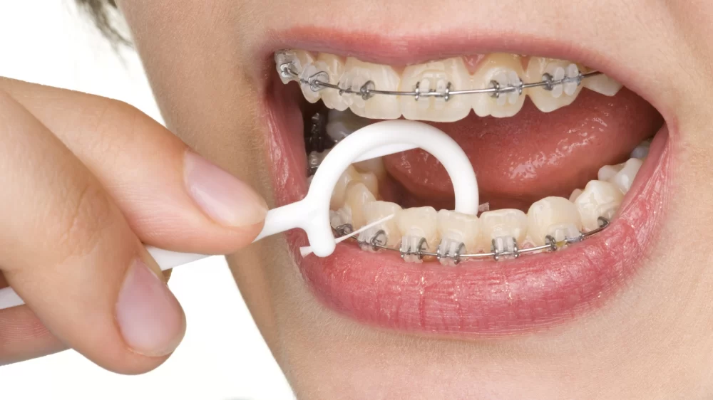 Effective Ways to Maintain Oral Hygiene with Braces for a Healthy Smile
