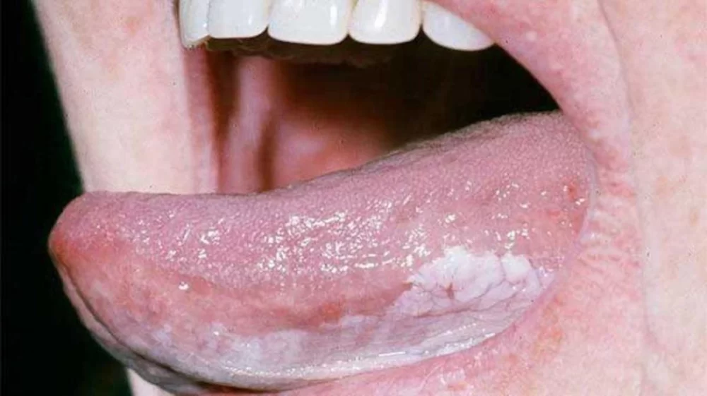 Recognizing Early Signs of Oral Cancer and Effective Diagnosis Care