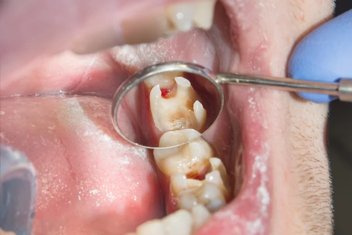 Effective Oral Care Solutions for Sensitive Teeth to Relieve Discomfort