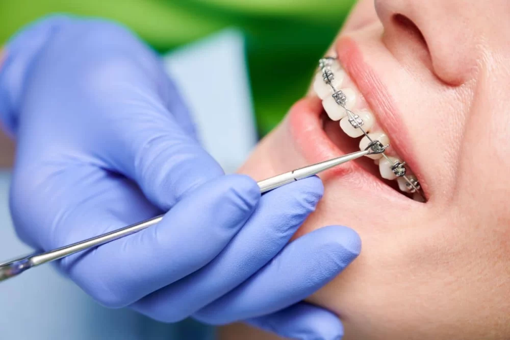 Effective Tips on How to Maintain Oral Hygiene with Braces for a Healthy Smile