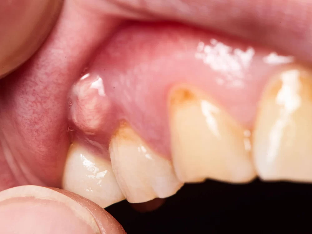 Recognizing Signs of Tooth Abscess: Pain Symptoms and Effective Treatment Options