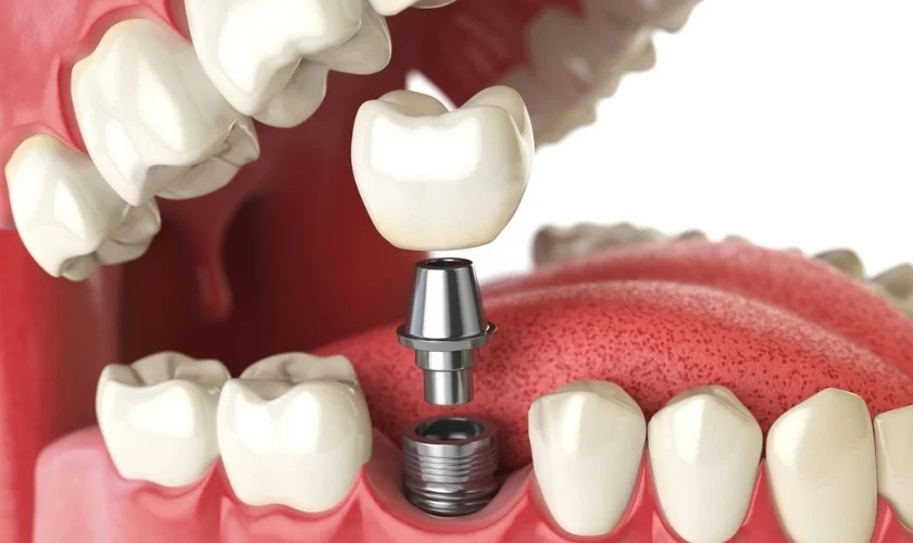 How to Care for Dental Implants After Cleaning and Maintenance Care for Long-Lasting Results