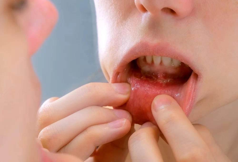 Recognizing the Early Signs of Oral Cancer for Timely Detection