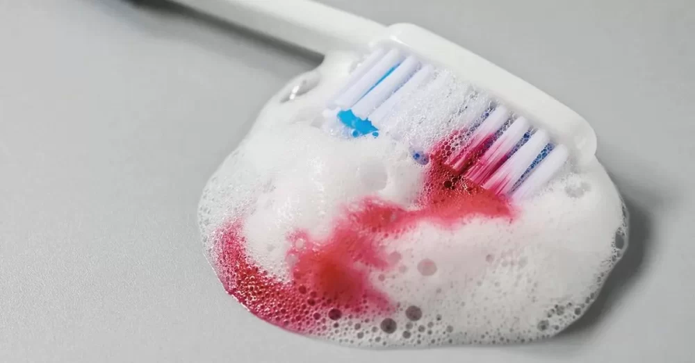 Effective Ways to Prevent Gum Bleeding After Dental Cleaning