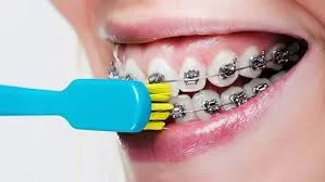 Effective Oral Hygiene Tips for Patients with Braces to Maintain Healthy Teeth