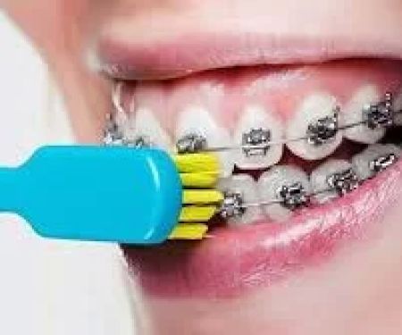 Effective Oral Hygiene Tips for Patients with Braces to Maintain Healthy Teeth