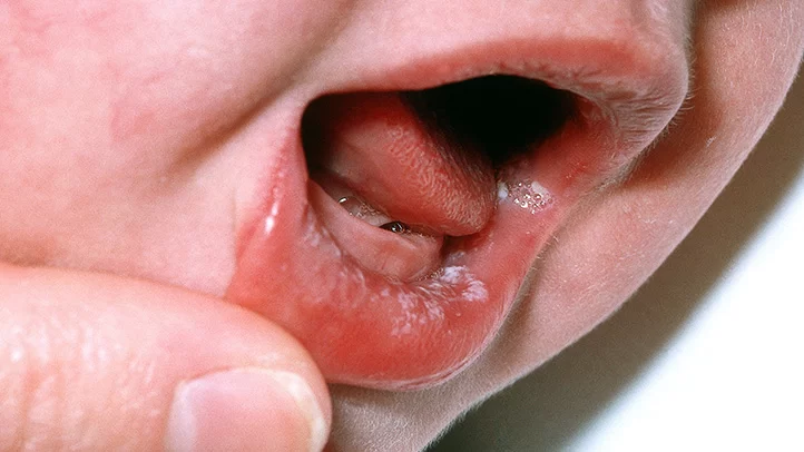 How to Effectively Treat Oral Thrush in Infants and Children
