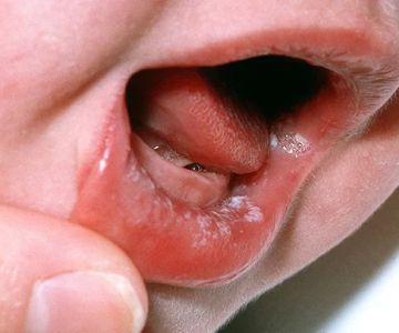 How to Effectively Treat Oral Thrush in Infants and Children