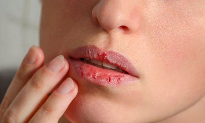 Understanding Causes of Dry Lips from Oral Health Issues and Effective Remedies