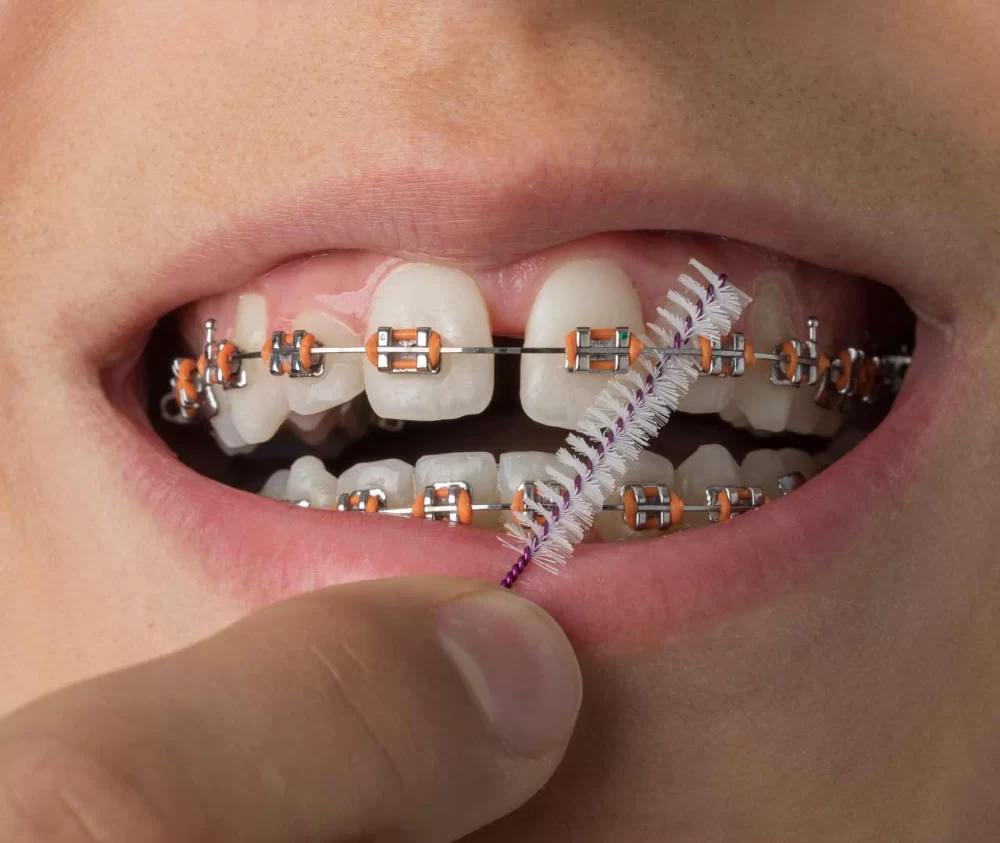 How to Clean Dental Braces Effectively for a Healthy Smile