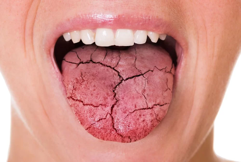 Effective Ways to Manage and Treat Dry Mouth Caused by Diabetes