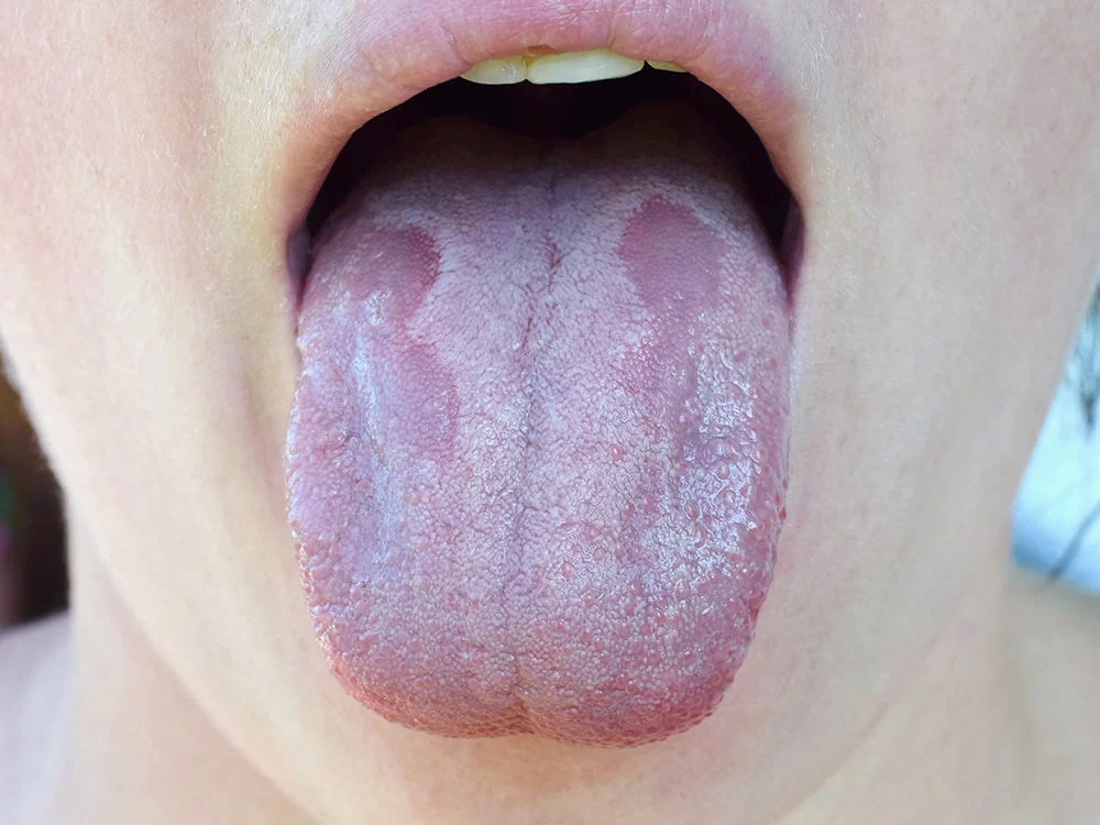 Natural and Effective Ways to Treat Oral Thrush in Adults