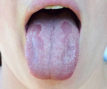 Natural and Effective Ways to Treat Oral Thrush in Adults