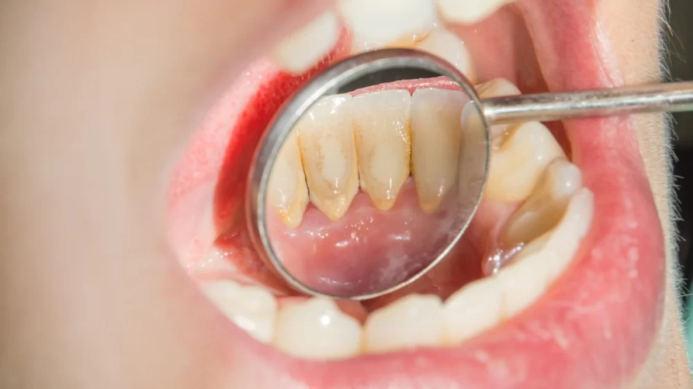 Effective Ways to Get Rid of Tartar Buildup at Home Safely