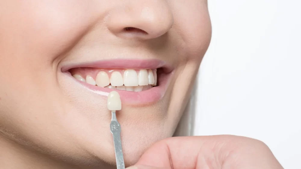 Effective Ways to Whiten Teeth After Braces Removal for a Radiant Smile