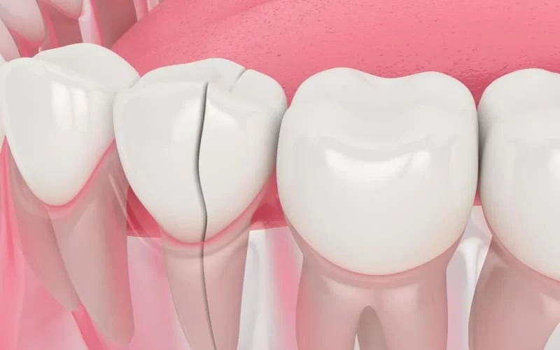 Effective Home Remedies for Cracked Tooth: How to Treat Cracked Tooth at Home