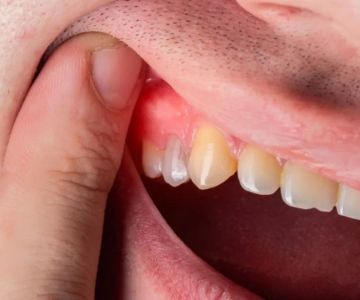 Effective Care and Treatment for Inflamed Gums After Eating and Brushing