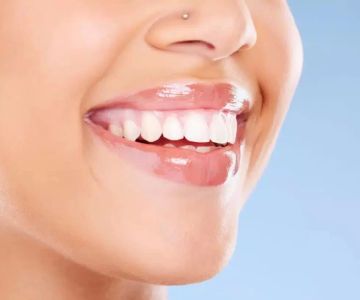 Effective Long Term Maintenance and Care for Dental Veneers