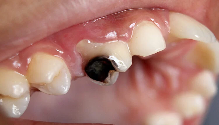 Effective Approaches for the Best Treatment for Tooth Decay