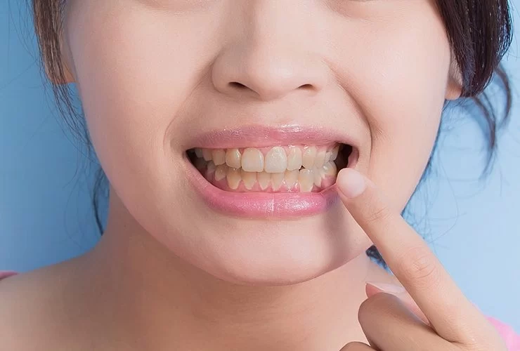Effective Natural Remedies to Fix Yellow Teeth at Home