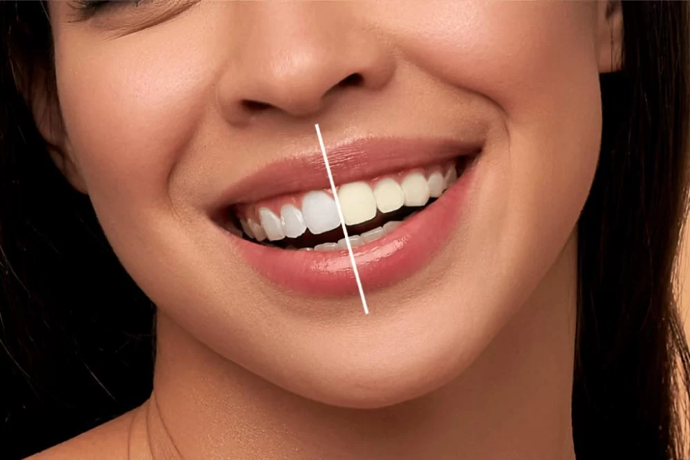 Understanding Causes of Tooth Pain After Whitening Treatments and How to Manage It