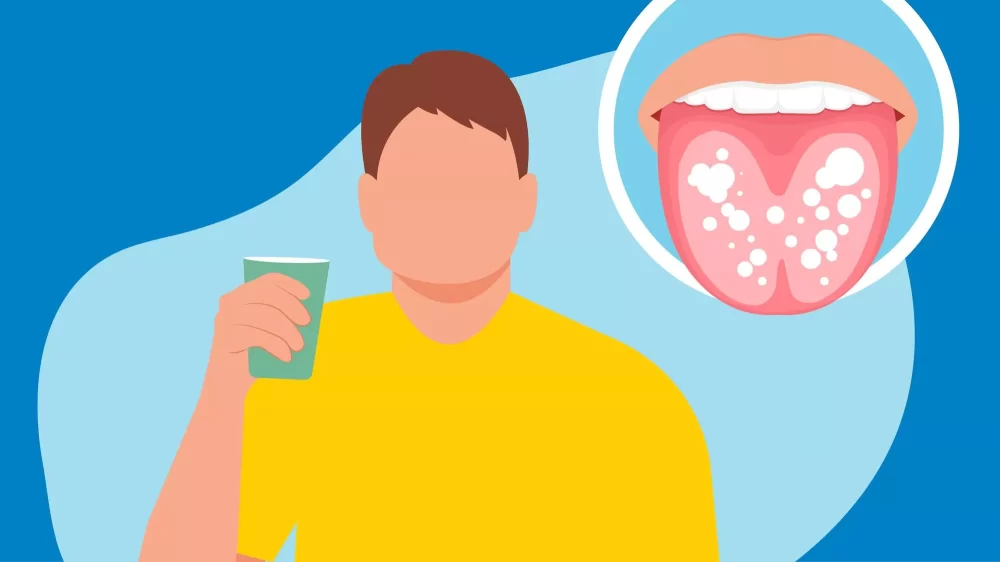 Effective Ways to Treat Oral Fungal Infections Naturally and Professionally