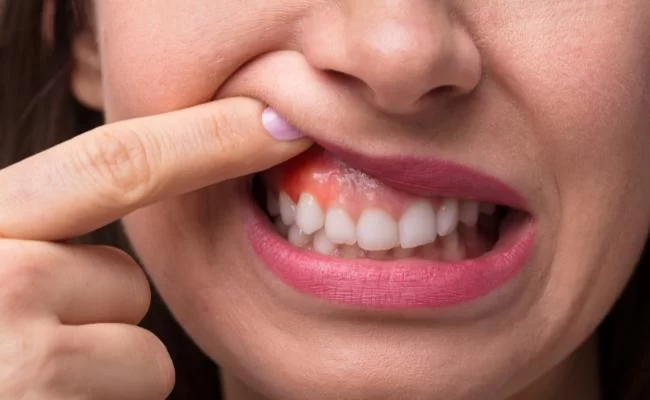 Understanding the Causes of Bleeding Gums and How to Address Them Effectively