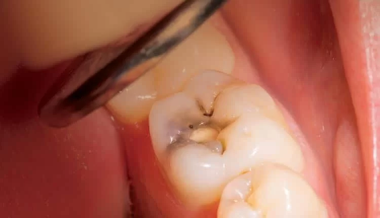 Effective and Safe Methods to Prevent Tooth Decay in Teenagers and Adults