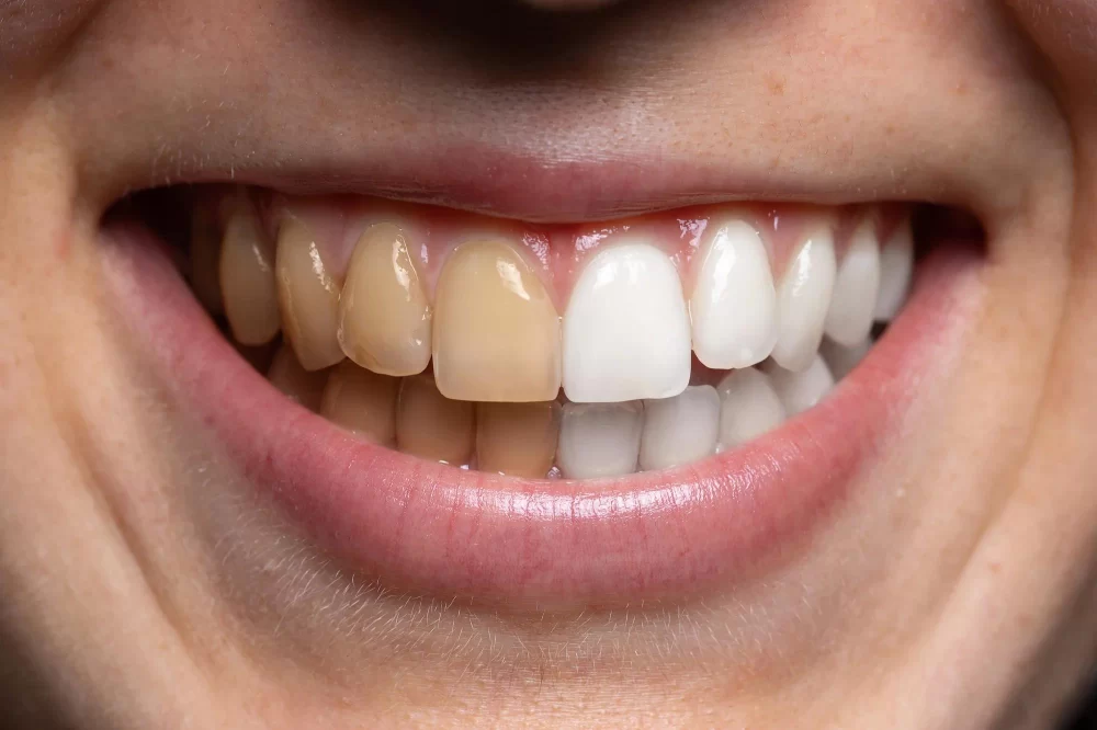 Effective Ways to Fix Teeth Staining from Tea and Coffee Consumption