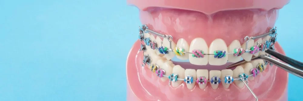How to Care for Dental Braces After Adjustment for Optimal Oral Health