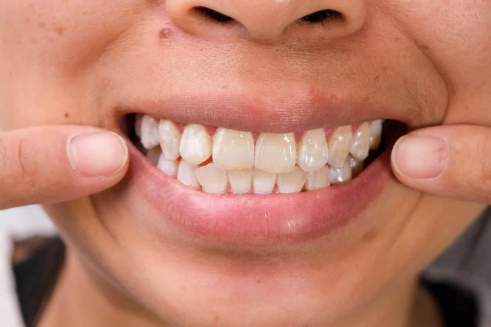 Causes of White Spots on Teeth and How to Address Them Effectively