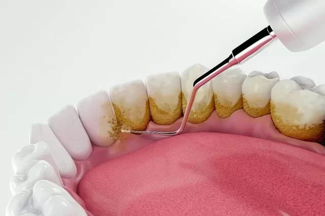 Natural and Effective Ways to Reduce Plaque for Healthier Teeth